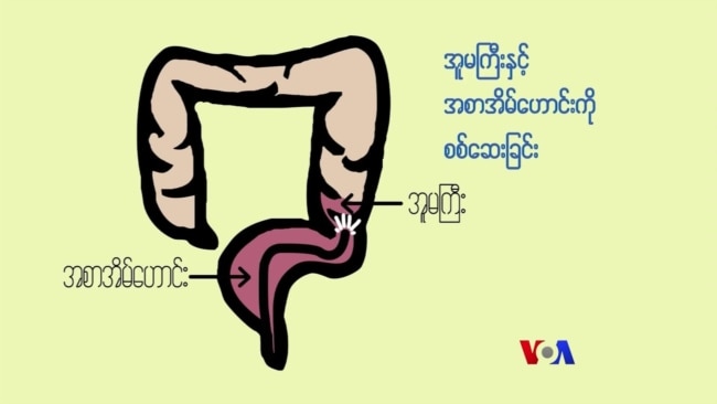 အူမကြီးကင်ဆာ ကုသနိုင်ဖို့ “လူထုနဲ့ ကျန်းမာရေး”