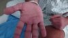 Dua Anak Didiagnosis Menderita Cacar Monyet di Amerika