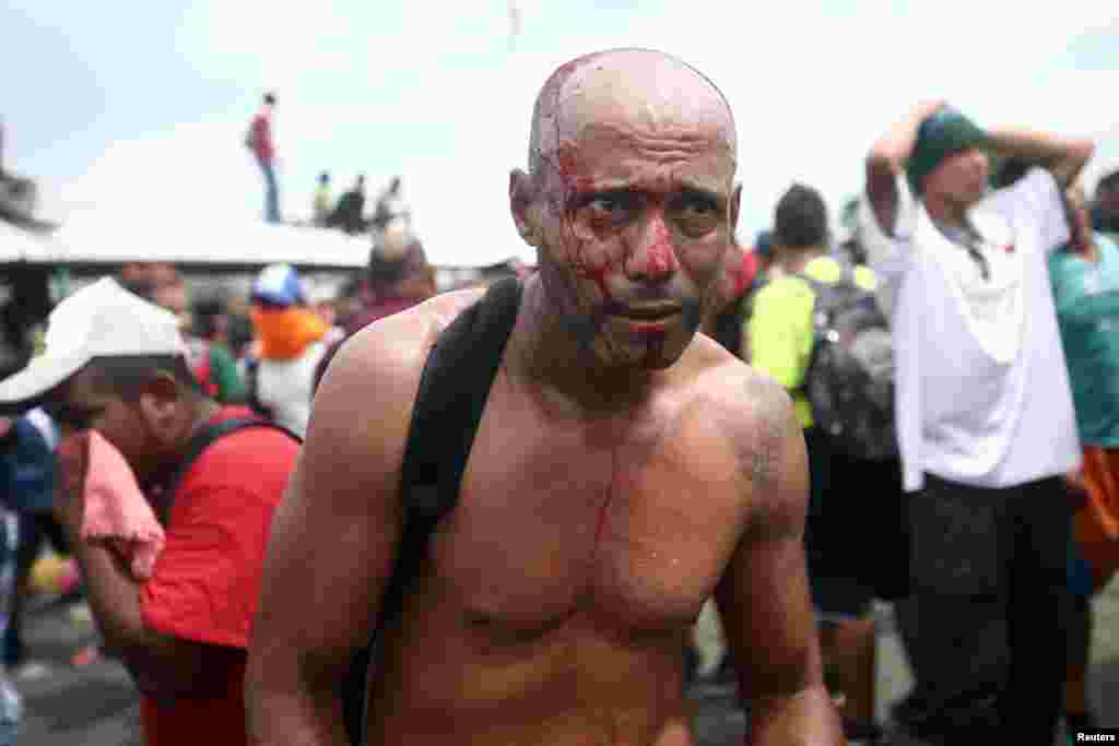 A Honduran migrant, part of a caravan trying to reach the U.S., bleeds after he storms a border checkpoint in Guatemala, in Ciudad Hidalgo, Mexico, Oct. 19, 2018.