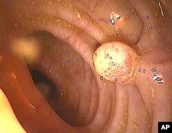 Colon Cancer Test