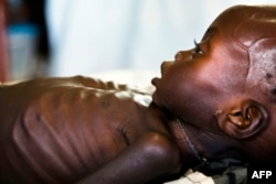 FILE - Agop Manut (11 months), who suffers acute malnutrition and respiratory distress, is assisted at the clinic run by Doctors without Borders (MSF) in Aweil, Northern Bahr al Ghazal, South Sudan, Oct. 11, 2016.