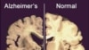 Mobile App Helps Alzheimer’s Caregivers
