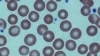 Terapi Efektif untuk Penderita “Sickle Cell Anemia”