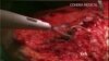 First Surgical Glue Approved for Use Inside Body