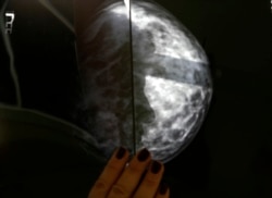Seorang pasien kanker payudara Yunani menunjukkan hasil x-ray setelah pemeriksaan radiologis di sebuah rumah sakit. (Foto: REUTERS/Yannis Behrakis)