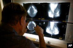 ILUSTRASI - Dr. Gerald Iba, memeriksa hasil mammogram di The Elizabeth Center for Cancer Detection, Los Angeles, 6 Agustus 2010.(AP/Damian Dovarganes)