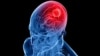La osteoporosis debilita los huesos y provoca fracturas dolorosas principalmente de cadera, columna vertebral y muñeca.