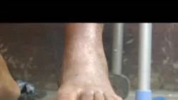 Hypertension na RDC