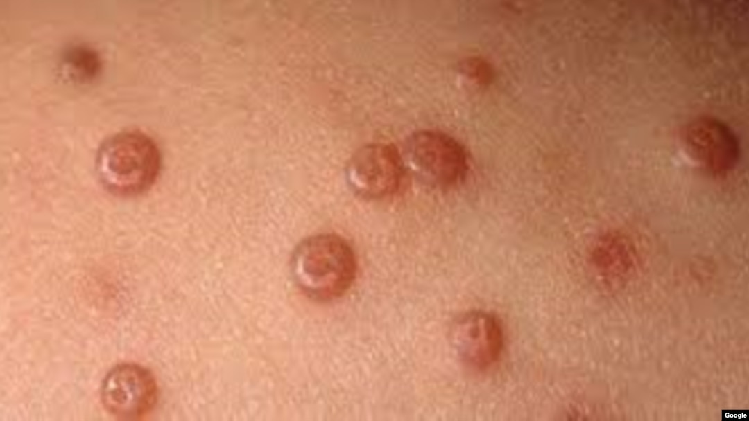 Molluscum Contagiosum