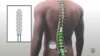 การรักษาแบบใหม่อาจช่วยให้ผู้ป่วยที่เป็นอัมพาตสามารถยืนหรือเดินได้อีกครั้ง