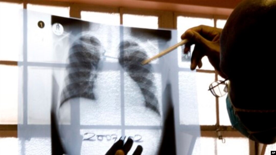 FILE - A doctor examines chest X-rays at a tuberculosis clinic in Gugulethu, Cape Town, South Africa in 2007.
