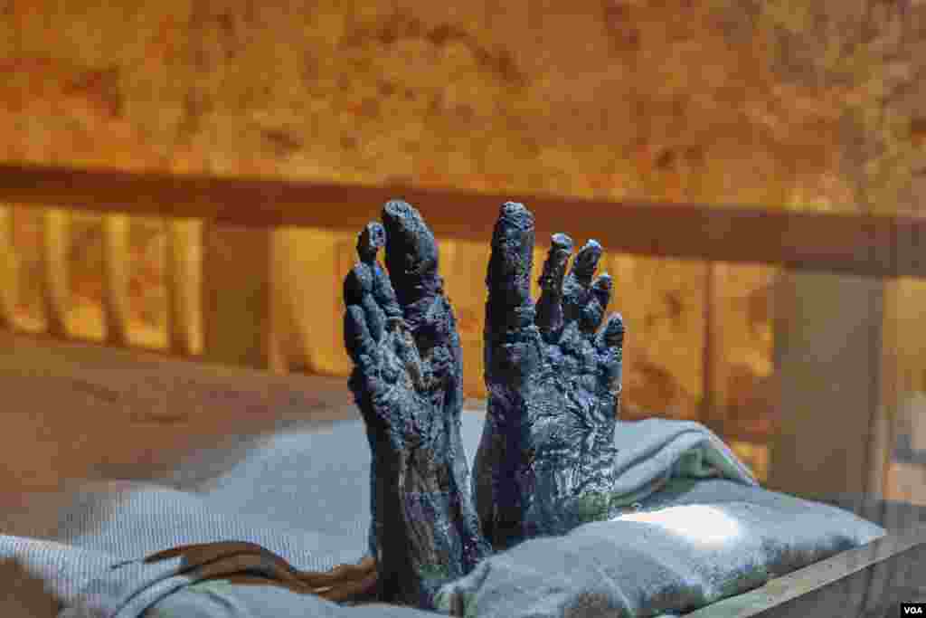 The feet of the boy king Tutankhamun show flatfoot on the left leg and deformity in the right leg. In ancient Egypt marriage between siblings was a long tradition, and inbreeding can lead to birth defects. (H. Elrasam/