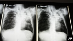 MDR-TB adalah penyakit yang kebal terhadap dua obat yang paling banyak digunakan dalam standar pengobatan TB. Sekitar 100 kasus MDR-TB di diagnosa setiap tahun di Amerika (foto: ilustrasi).