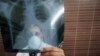 Kenya Rolls Out New Child-friendly TB Drugs